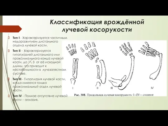 Классификация врождённой лучевой косорукости Тип I - Характеризуется частичным недоразвитием