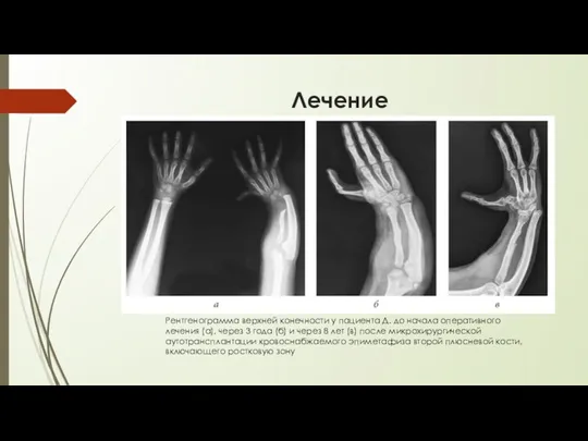 Лечение Рентгенограмма верхней конечности у пациента Д. до начала оперативного