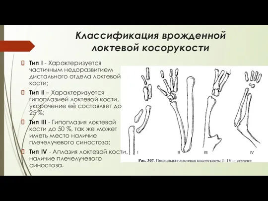 Классификация врожденной локтевой косорукости Тип I - Характеризуется частичным недоразвитием