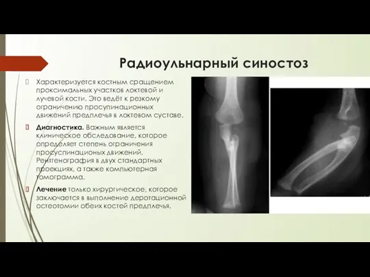 Радиоульнарный синостоз Характеризуется костным сращением проксимальных участков локтевой и лучевой