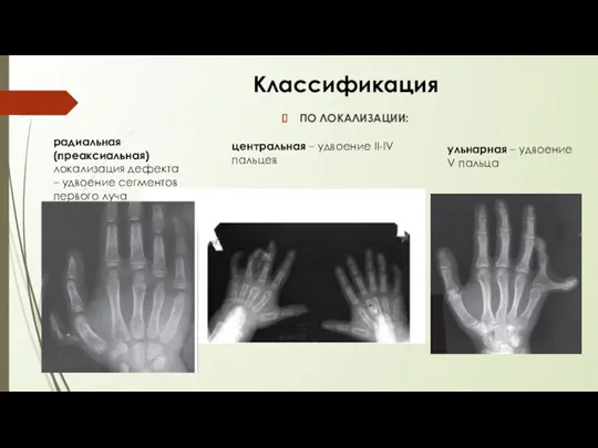 Классификация ПО ЛОКАЛИЗАЦИИ: радиальная (преаксиальная) локализация дефекта – удвоение сегментов