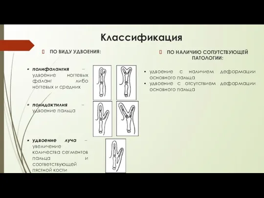 Классификация ПО ВИДУ УДВОЕНИЯ: ПО НАЛИЧИЮ СОПУТСТВУЮЩЕЙ ПАТОЛОГИИ: полифалангия –