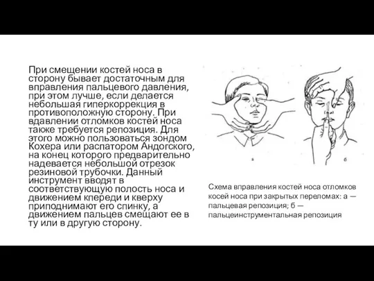 При смещении костей носа в сторону бывает достаточным для вправления пальцевого давления, при