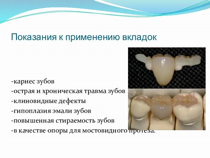 Показания к применению вкладок -кариес зубов -острая и хроническая травма