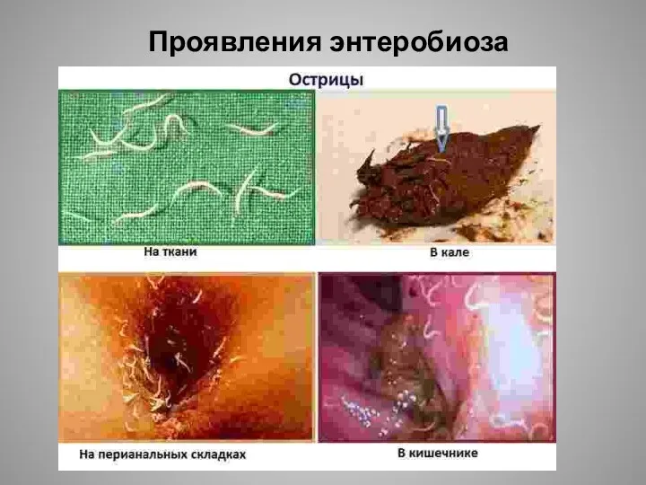 Проявления энтеробиоза