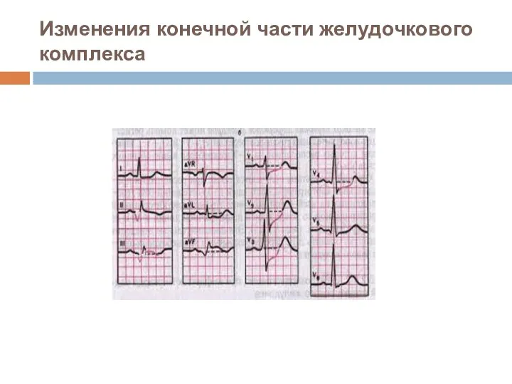 Изменения конечной части желудочкового комплекса