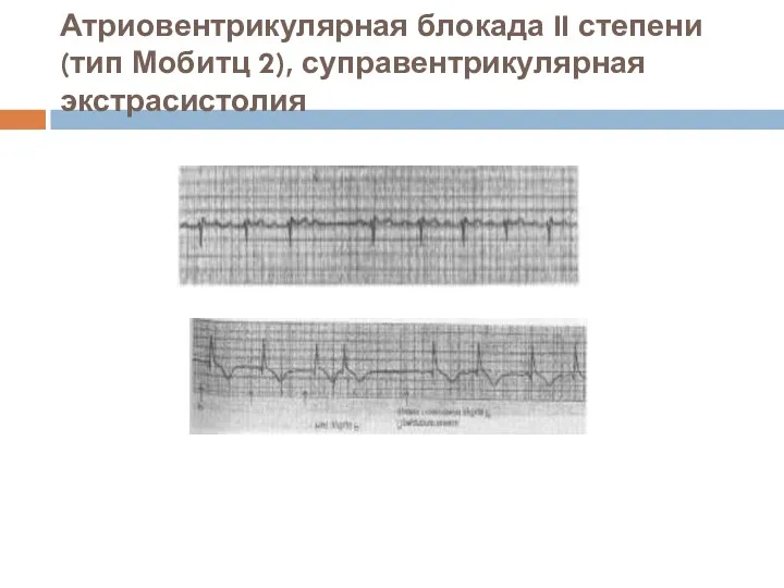 Атриовентрикулярная блокада II степени (тип Мобитц 2), суправентрикулярная экстрасистолия
