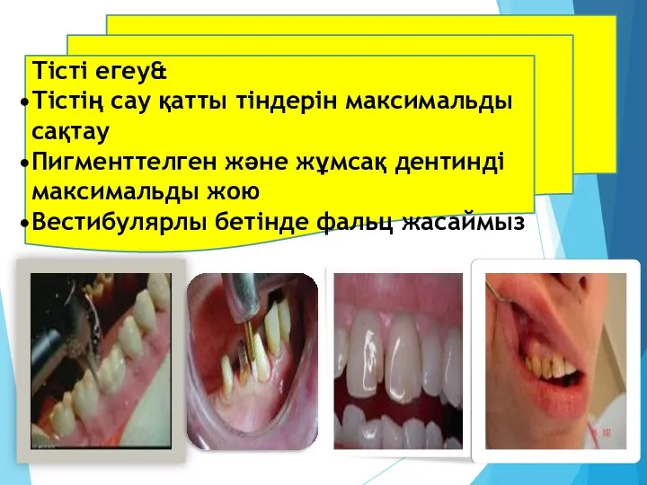 Тісті егеу& Тістің сау қатты тіндерін максимальды сақтау Пигменттелген және