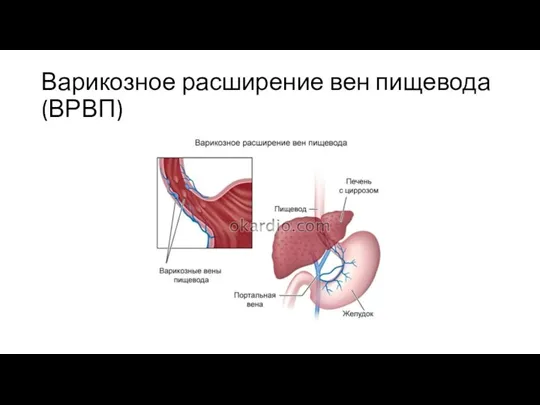 Варикозное расширение вен пищевода (ВРВП)