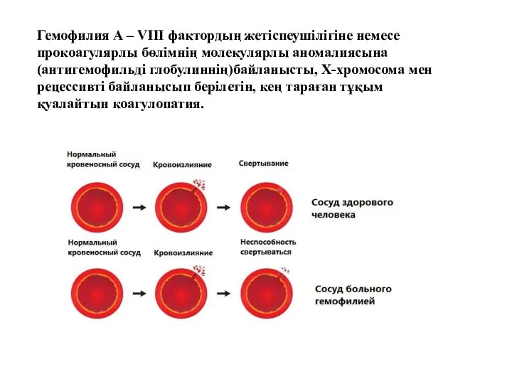Гемофилия А – VIII фактордың жетіспеушілігіне немесе прокоагулярлы бөлімнің молекулярлы аномалиясына (антигемофильді глобулиннің)байланысты,
