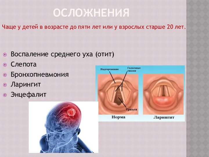 ОСЛОЖНЕНИЯ Воспаление среднего уха (отит) Слепота Бронхопневмония Ларингит Энцефалит Чаще