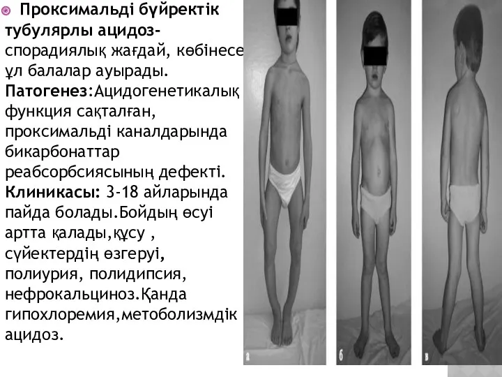 Проксимальді бүйректік тубулярлы ацидоз- спорадиялық жағдай, көбінесе ұл балалар ауырады.