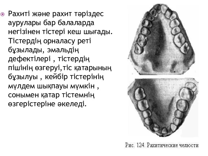 Рахиті және рахит тәріздес аурулары бар балаларда негізінен тістері кеш