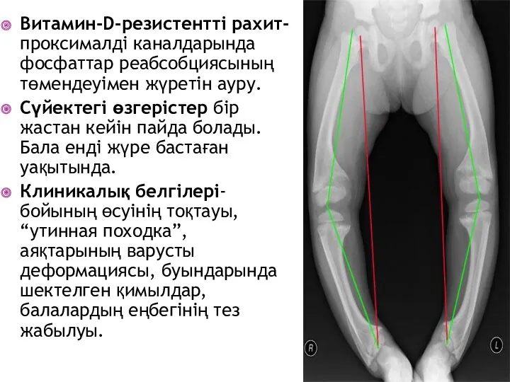 Витамин-D-резистентті рахит- проксималді каналдарында фосфаттар реабсобциясының төмендеуімен жүретін ауру. Сүйектегі