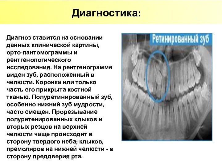 Диагностика: Диагноз ставится на основании данных клинической картины, орто-пантомограммы и