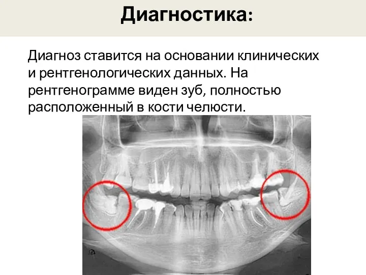 Диагностика: Диагноз ставится на основании клинических и рентгенологических данных. На