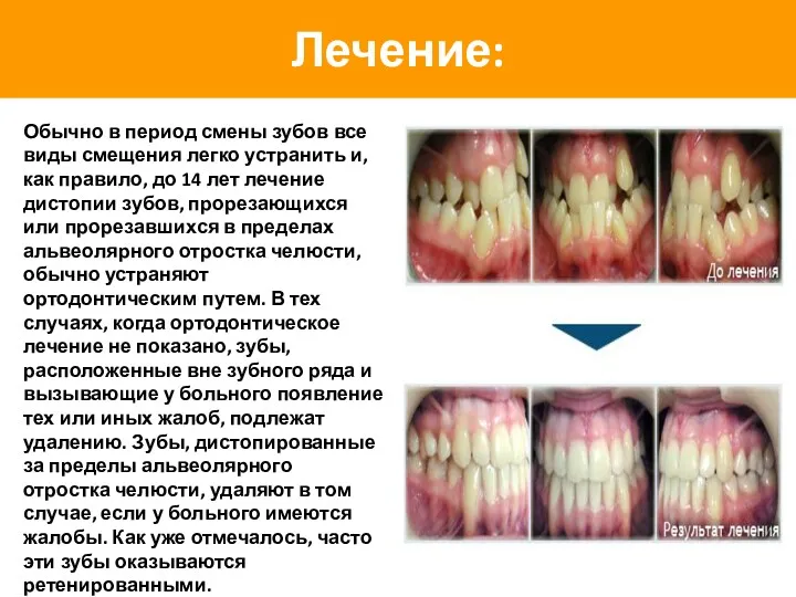 Лечение: Обычно в период смены зубов все виды смещения легко