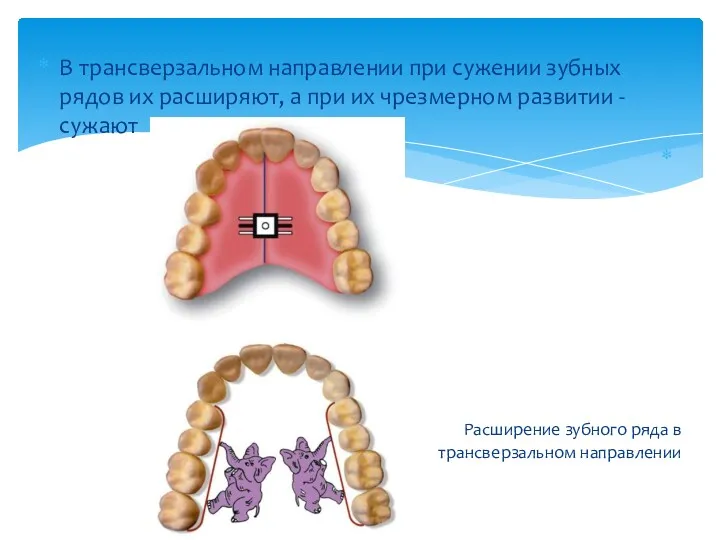 В трансверзальном направлении при сужении зубных рядов их расширяют, а