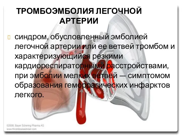 ТРОМБОЭМБОЛИЯ ЛЕГОЧНОЙ АРТЕРИИ синдром, обусловленный эмболией легочной артерии или ее