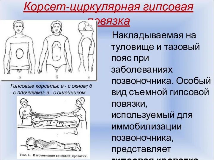 Корсет-циркулярная гипсовая повязка Накладываемая на туловище и тазовый пояс при