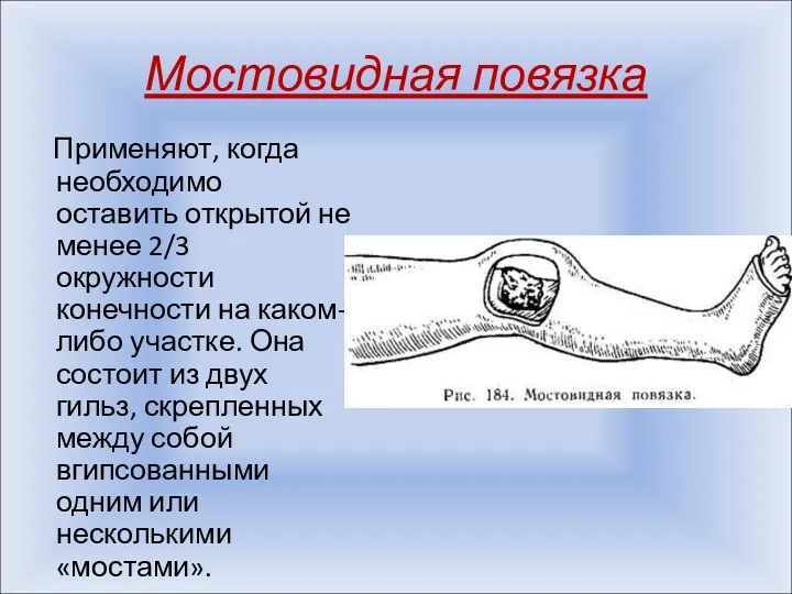 Мостовидная повязка Применяют, когда необходимо оставить открытой не менее 2/3