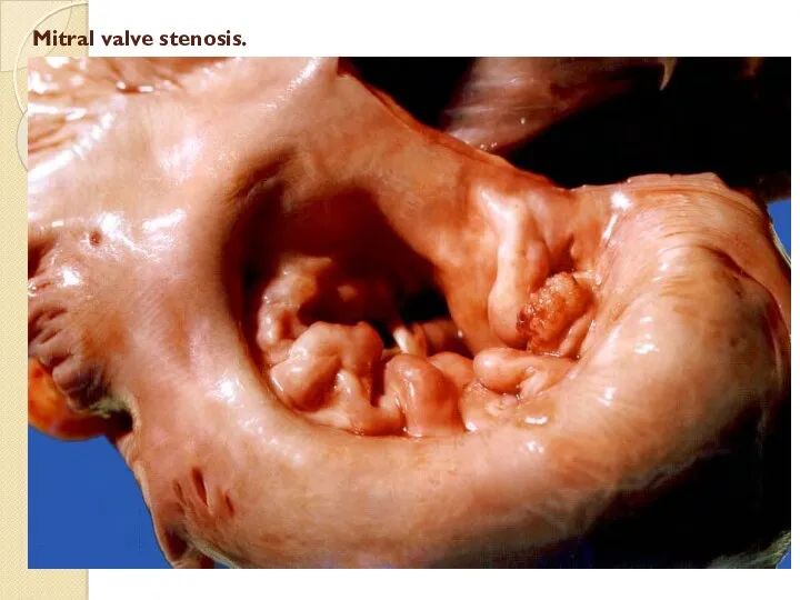 Mitral valve stenosis.