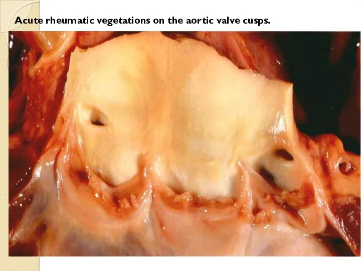 Acute rheumatic vegetations on the aortic valve cusps.