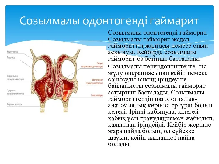 Созылмалы одонтогенді гаймарит Созылмалы одонтогенді гайморит. Созылмалы гайморит жедел гаймориттің