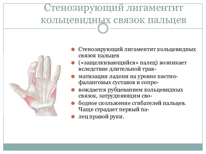 Стенозирующий лигаментит кольцевидных связок пальцев Стенозирующий лигаментит кольцевидных связок пальцев