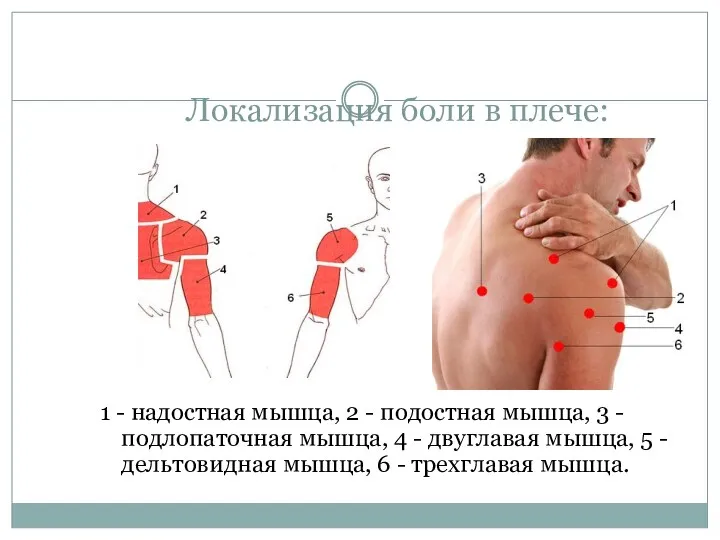 Локализация боли в плече: 1 - надостная мышца, 2 -