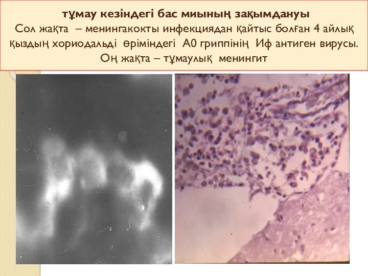 тұмау кезіндегі бас миының зақымдануы Сол жақта – менингакокты инфекциядан