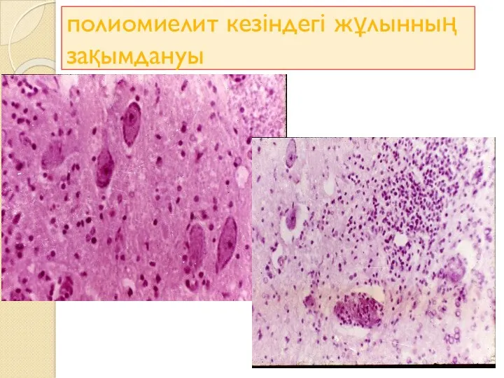 полиомиелит кезіндегі жұлынның зақымдануы