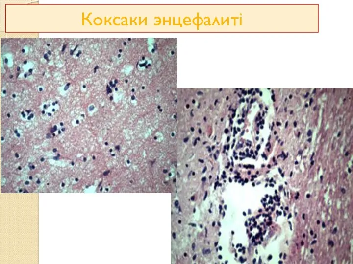 Коксаки энцефалиті