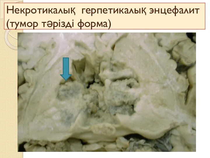 Некротикалық герпетикалық энцефалит (тумор тәрізді форма)