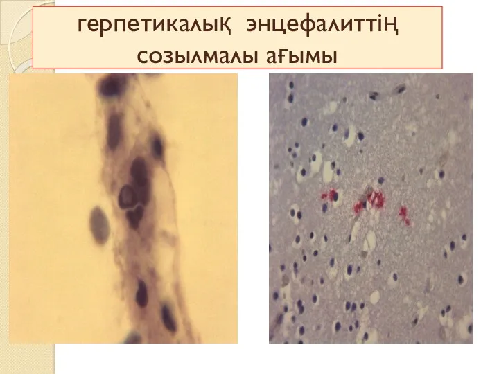 герпетикалық энцефалиттің созылмалы ағымы