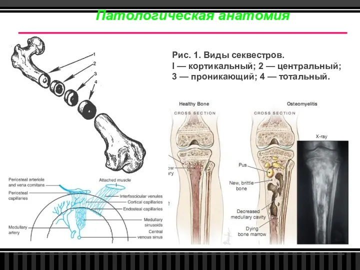 Патологическая анатомия Рис. 1. Виды секвестров. I — кортикальный; 2 — центральный; 3