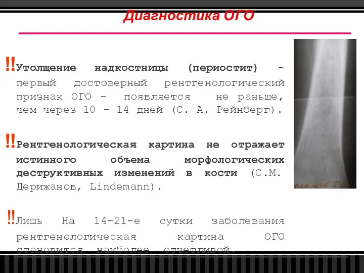 Диагностика ОГО Утолщение надкостницы (периостит) - первый достоверный рентгенологический признак