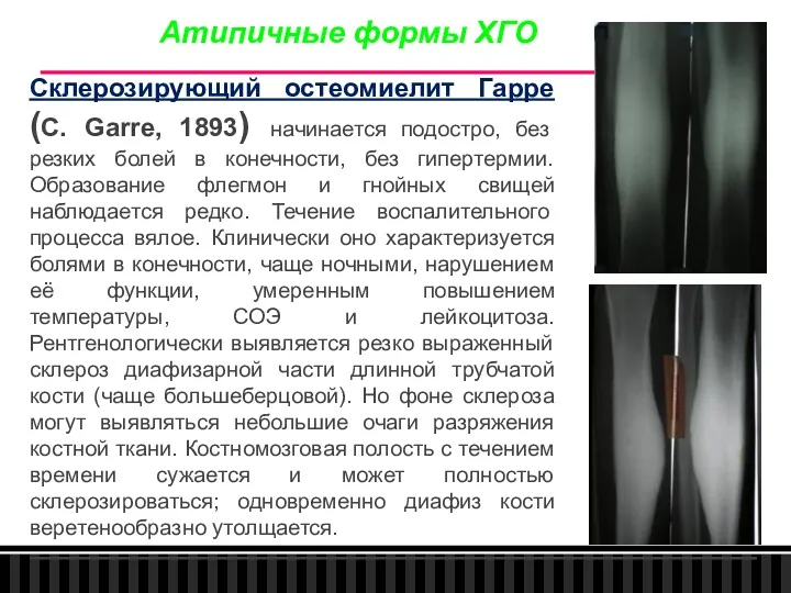 Склерозирующий остеомиелит Гарре (С. Garre, 1893) начинается подостро, без резких болей в конечности,