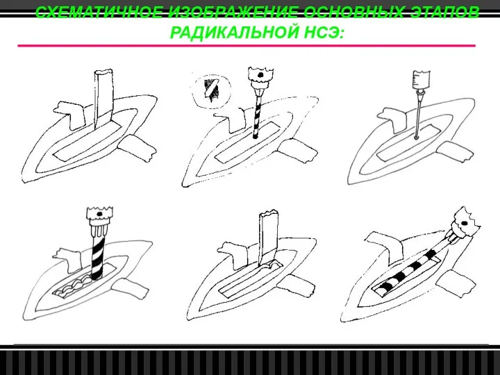 СХЕМАТИЧНОЕ ИЗОБРАЖЕНИЕ ОСНОВНЫХ ЭТАПОВ РАДИКАЛЬНОЙ НСЭ: