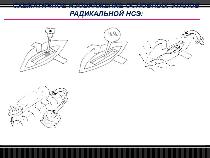 СХЕМАТИЧНОЕ ИЗОБРАЖЕНИЕ ОСНОВНЫХ ЭТАПОВ РАДИКАЛЬНОЙ НСЭ: