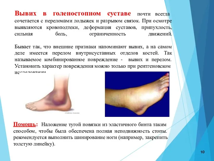 Вывих в голеностопном суставе почти всегда сочетается с переломами лодыжек