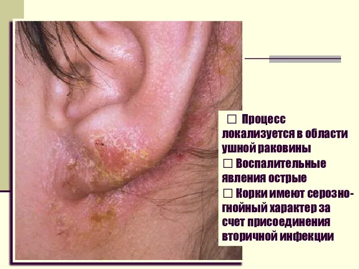  Процесс локализуется в области ушной раковины  Воспалительные явления