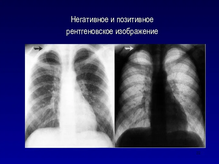 Негативное и позитивное рентгеновское изображение