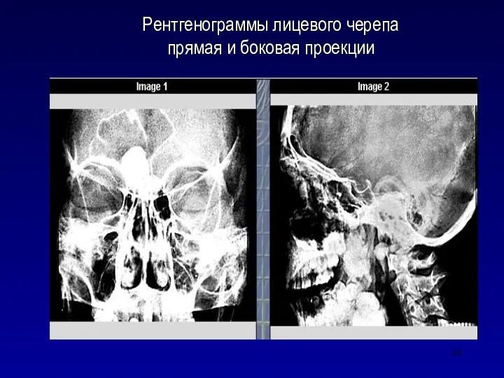 Рентгенограммы лицевого черепа прямая и боковая проекции