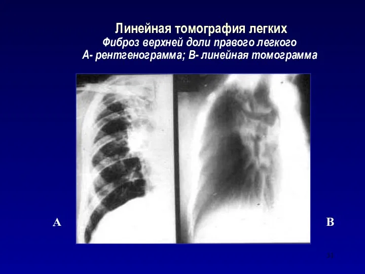 Линейная томография легких Фиброз верхней доли правого легкого А- рентгенограмма; В- линейная томограмма А В
