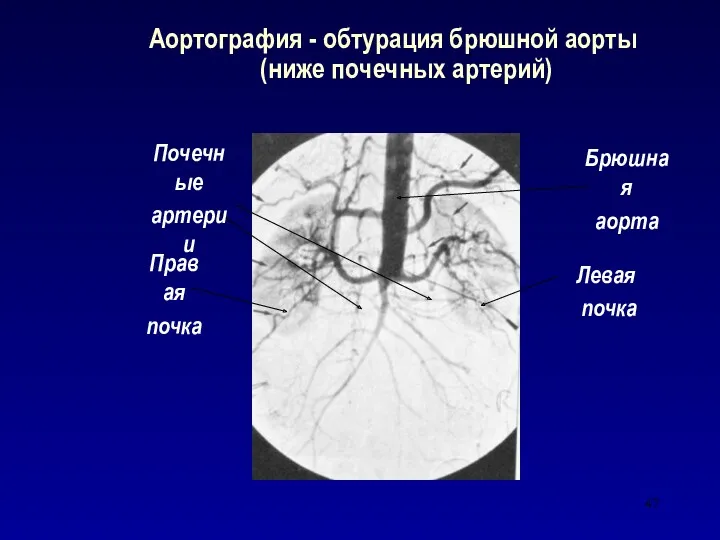 Аортография - обтурация брюшной аорты (ниже почечных артерий) Правая почка Почечные артерии Левая почка Брюшная аорта