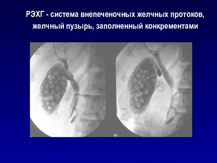 РЭХГ - система внепеченочных желчных протоков, желчный пузырь, заполненный конкрементами