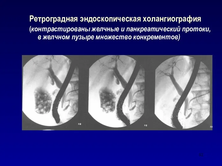 Ретроградная эндоскопическая холангиография (контрастированы желчные и панкреатический протоки, в желчном пузыре множество конкрементов)