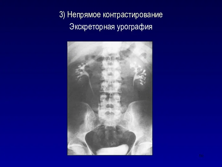 3) Непрямое контрастирование Экскреторная урография