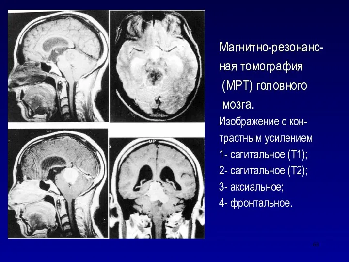 Магнитно-резонанс- ная томография (МРТ) головного мозга. Изображение с кон- трастным